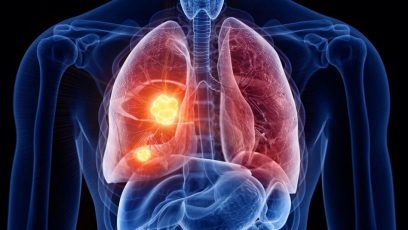 Lung Cancer