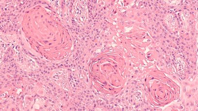 Lung Cancer